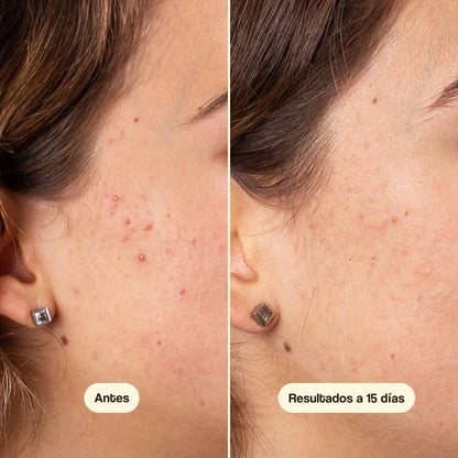 Crema Facial Anti-Acné Azelaic Radiance Freshly 50ml